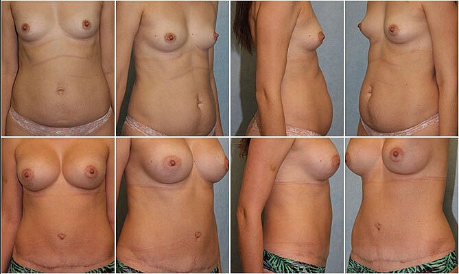 Mommy Makeover Before & After