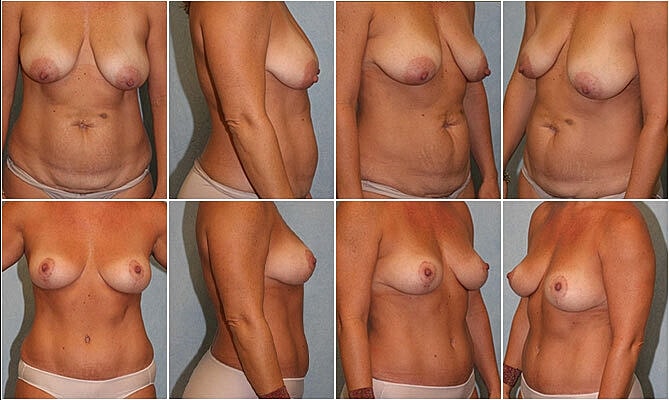 Mommy Makeover Before & After
