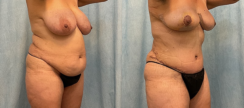 Mommy Makeover Before & After