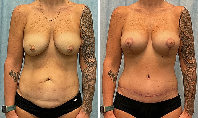 Mommy Makeover Before & After