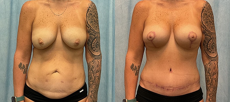 Mommy Makeover Before & After