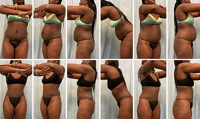 Mommy Makeover Before & After