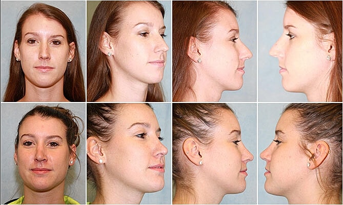 Rhinoplasty Before & After