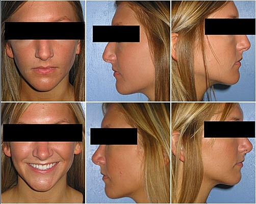 Rhinoplasty Before & After