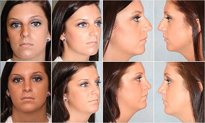 Rhinoplasty Before & After