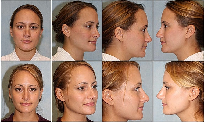 Rhinoplasty Before & After