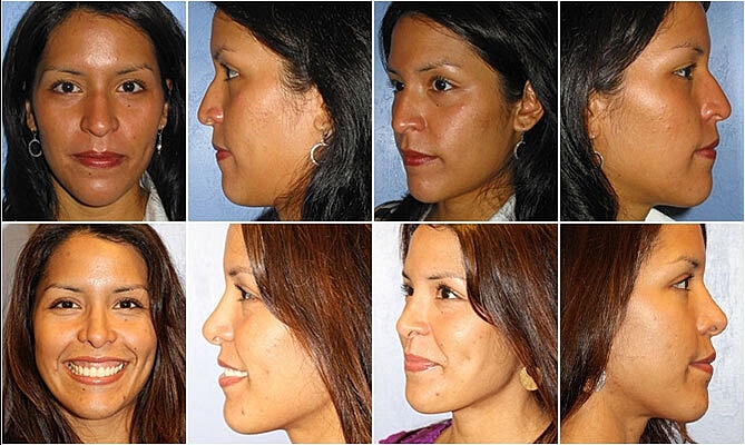 Rhinoplasty Before & After