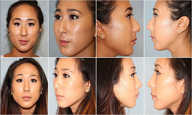 Rhinoplasty Before & After
