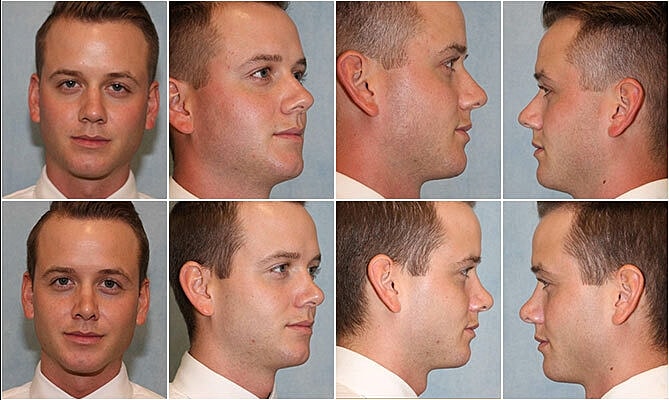 Rhinoplasty Before & After