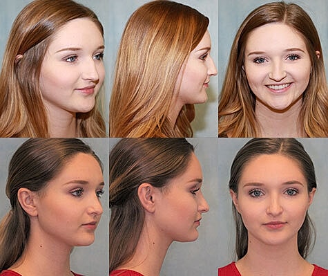 Rhinoplasty Before & After