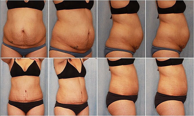 Tummy Tuck Before & After