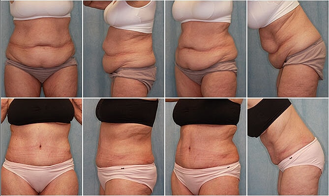 Tummy Tuck Before & After