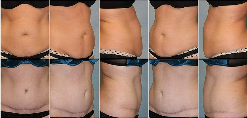 Tummy Tuck Before & After
