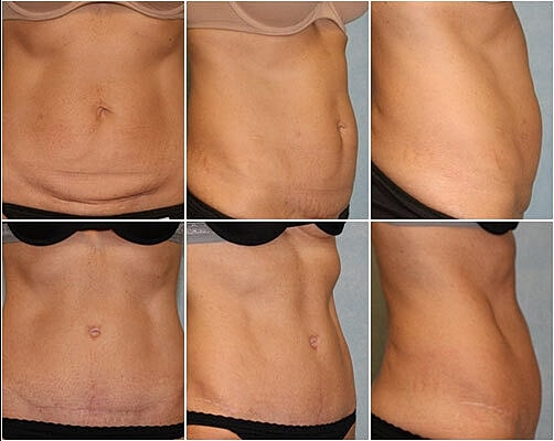Tummy Tuck Before & After