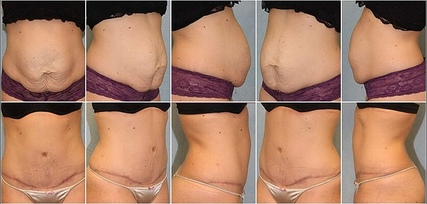 Tummy Tuck Before & After