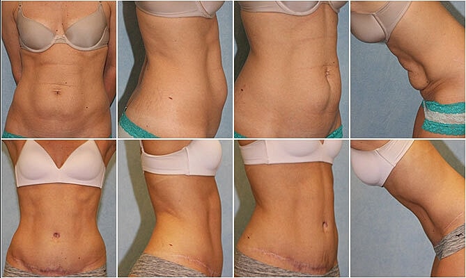 Tummy Tuck Before & After