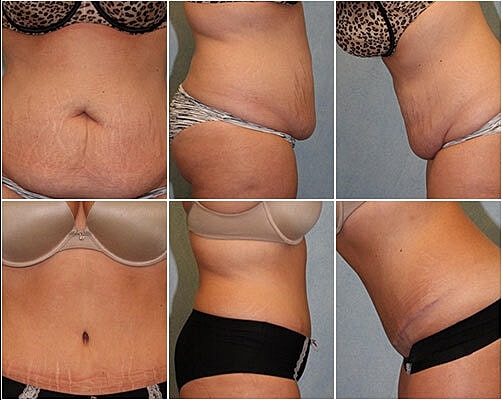 Tummy Tuck Before & After