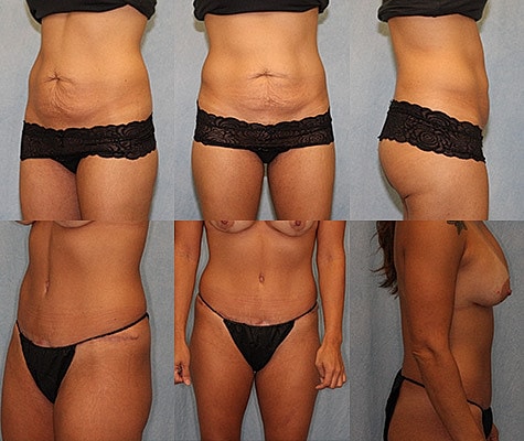 Tummy Tuck Before & After