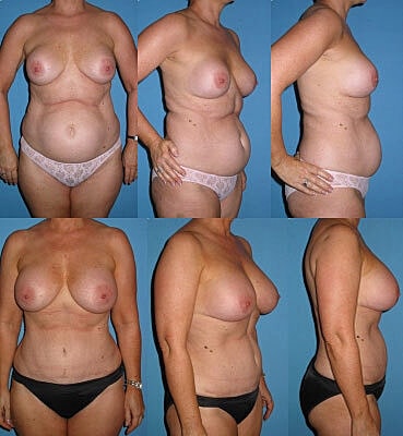 Tummy Tuck Before & After