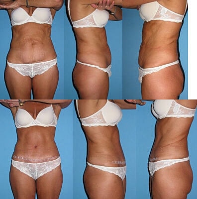 Tummy Tuck Before & After