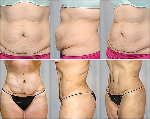 Tummy Tuck Before & After