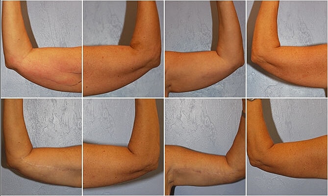 Brachioplasty Before & After