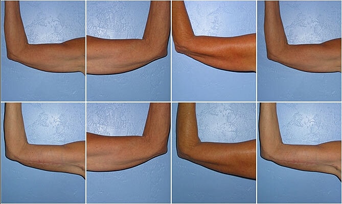 Brachioplasty Before & After