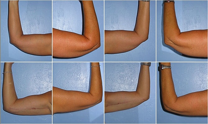 Brachioplasty Before & After