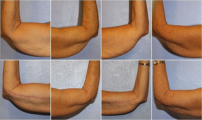 Brachioplasty Before & After