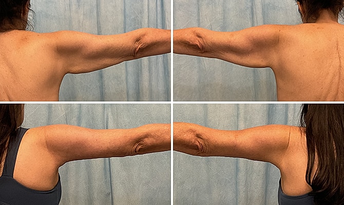 Brachioplasty Before & After