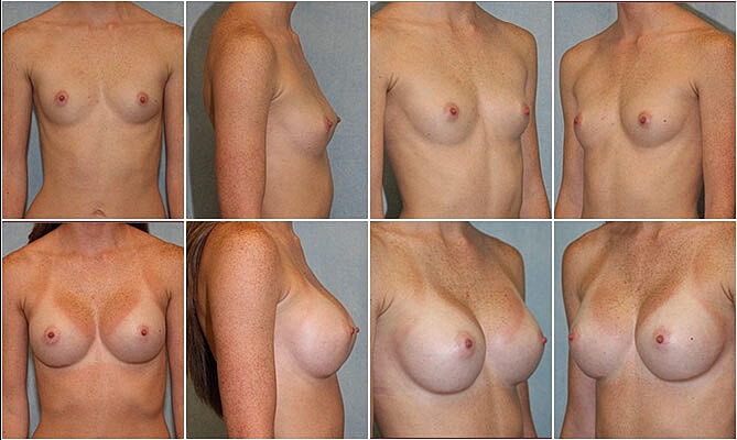 Breast Augmentation Before & After