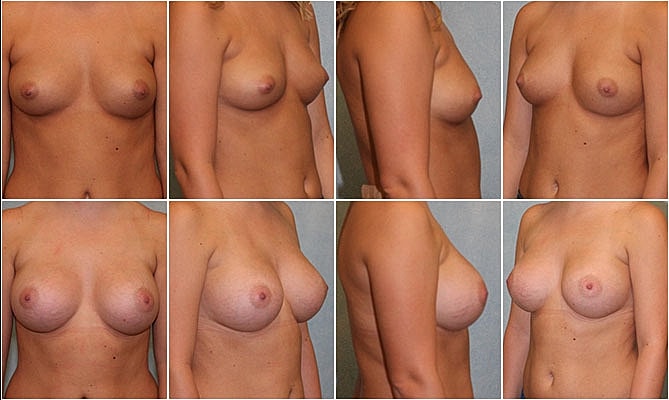 Breast Augmentation Before & After