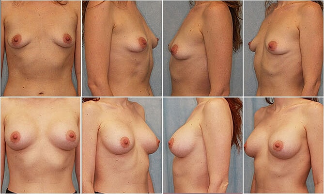 Breast Augmentation Before & After
