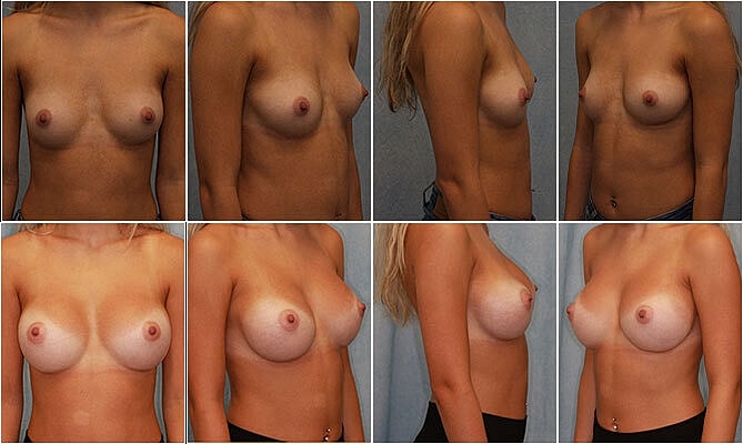 Breast Augmentation Before & After