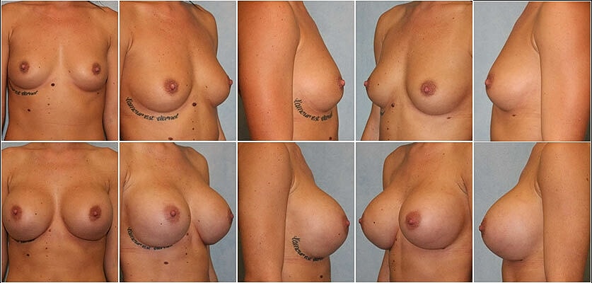 Breast Augmentation Before & After