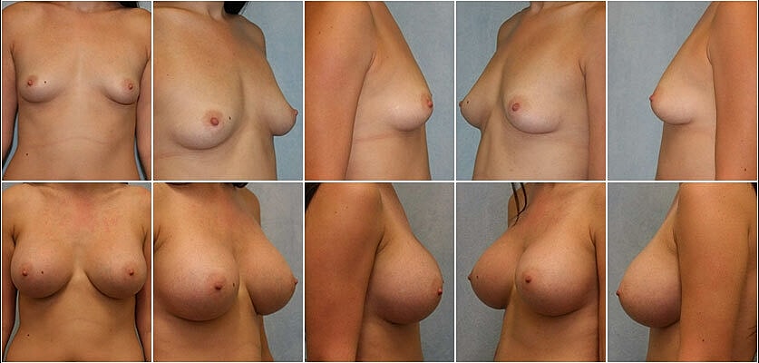 Breast Augmentation Before & After
