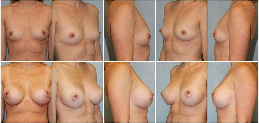 Breast Augmentation Before & After