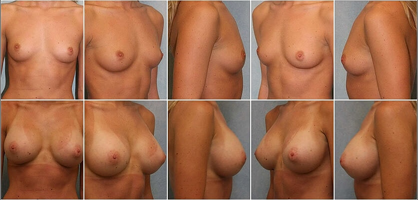 Breast Augmentation Before & After
