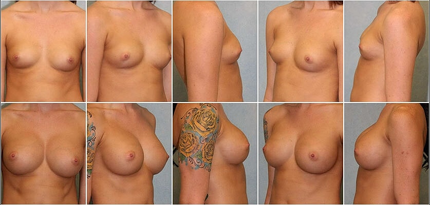 Breast Augmentation Before & After