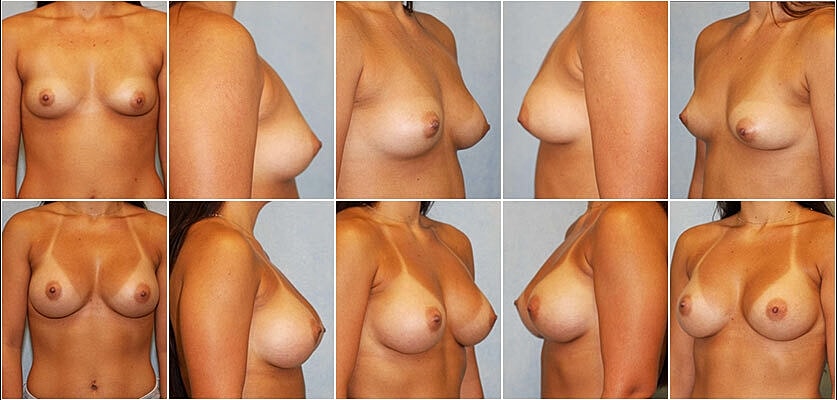 Breast Augmentation Before & After