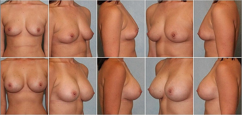 Breast Augmentation Before & After