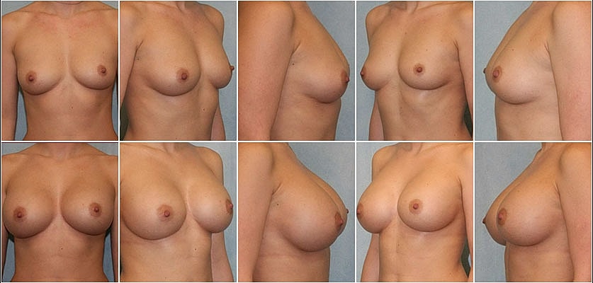 Breast Augmentation Before & After