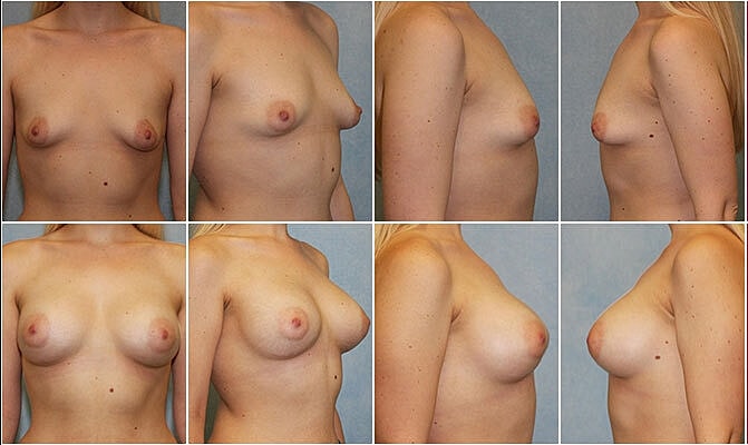 Breast Augmentation Before & After