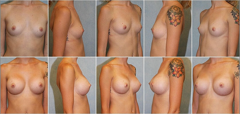 Breast Augmentation Before & After