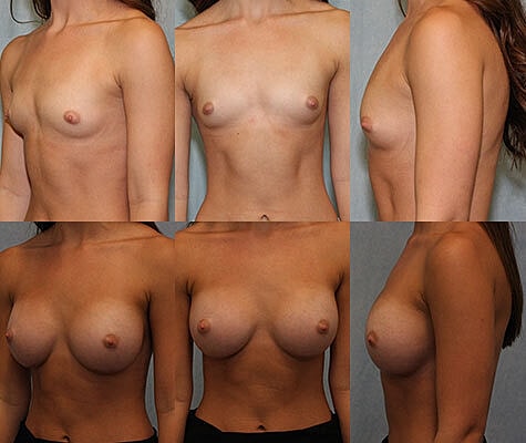 Breast Augmentation Before & After