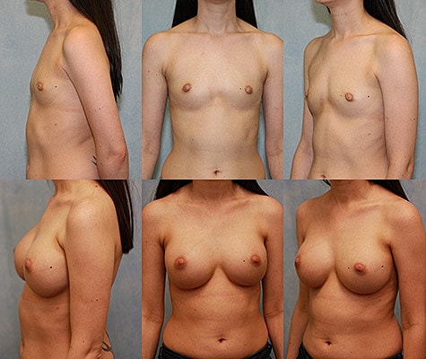 Breast Augmentation Before & After