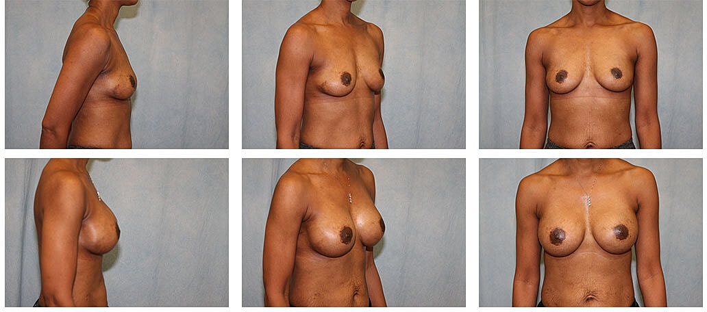 Breast Augmentation Before & After