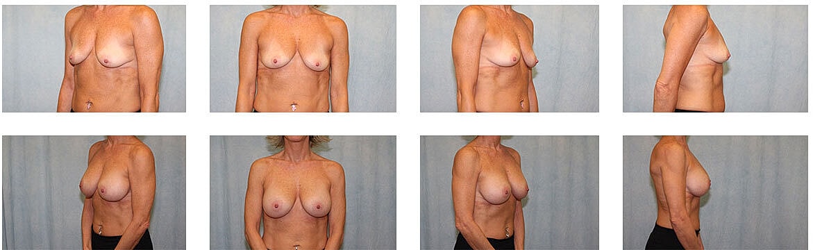 Breast Augmentation Before & After