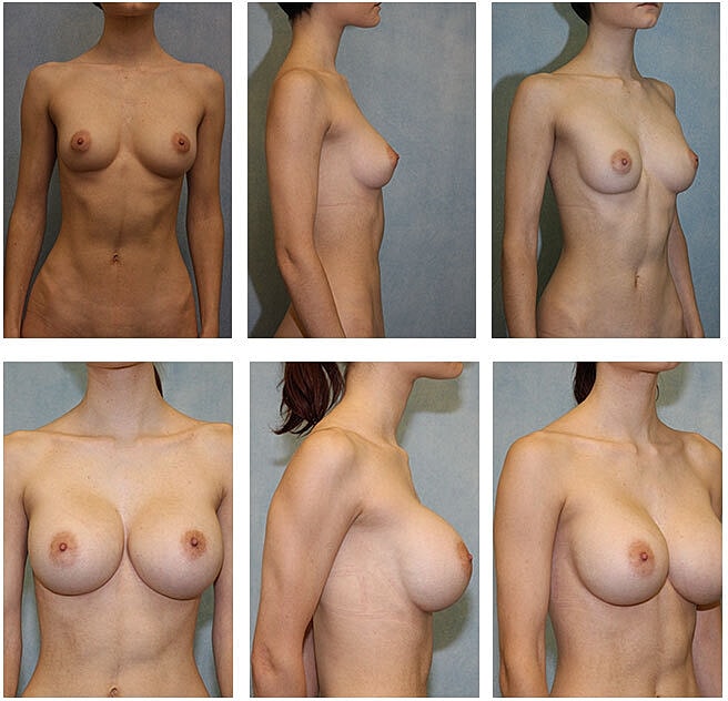 Breast Augmentation Before & After