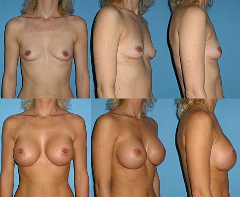Breast Augmentation Before & After